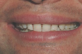 Ortodonzia immediata: le faccette in ceramica - Apparecchio Invisibile Firenze