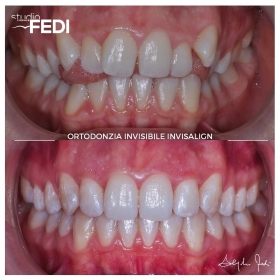 Risolto morso aperto grave : Dr. A. Fedi con Invisalign - Apparecchio Invisibile Firenze