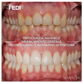 Invisalign a Firenze è rapido e veloce - Apparecchio Invisibile Firenze