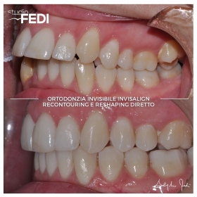 Risoluzione con Invisalign di seconda classe in adulto - Apparecchio Invisibile Firenze